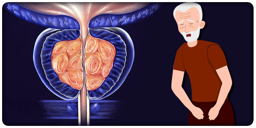 KÄMPAR DU MED EN BESVÄRLIG PROSTATA?  Se hur män som du har hittat lindring